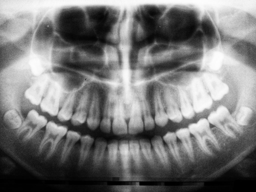 découvrez tout ce qu'il faut savoir sur les implants dentaires : avantages, procédures, soins et résultats. transformez votre sourire et retrouvez confiance grâce à des solutions dentaires innovantes et durables.